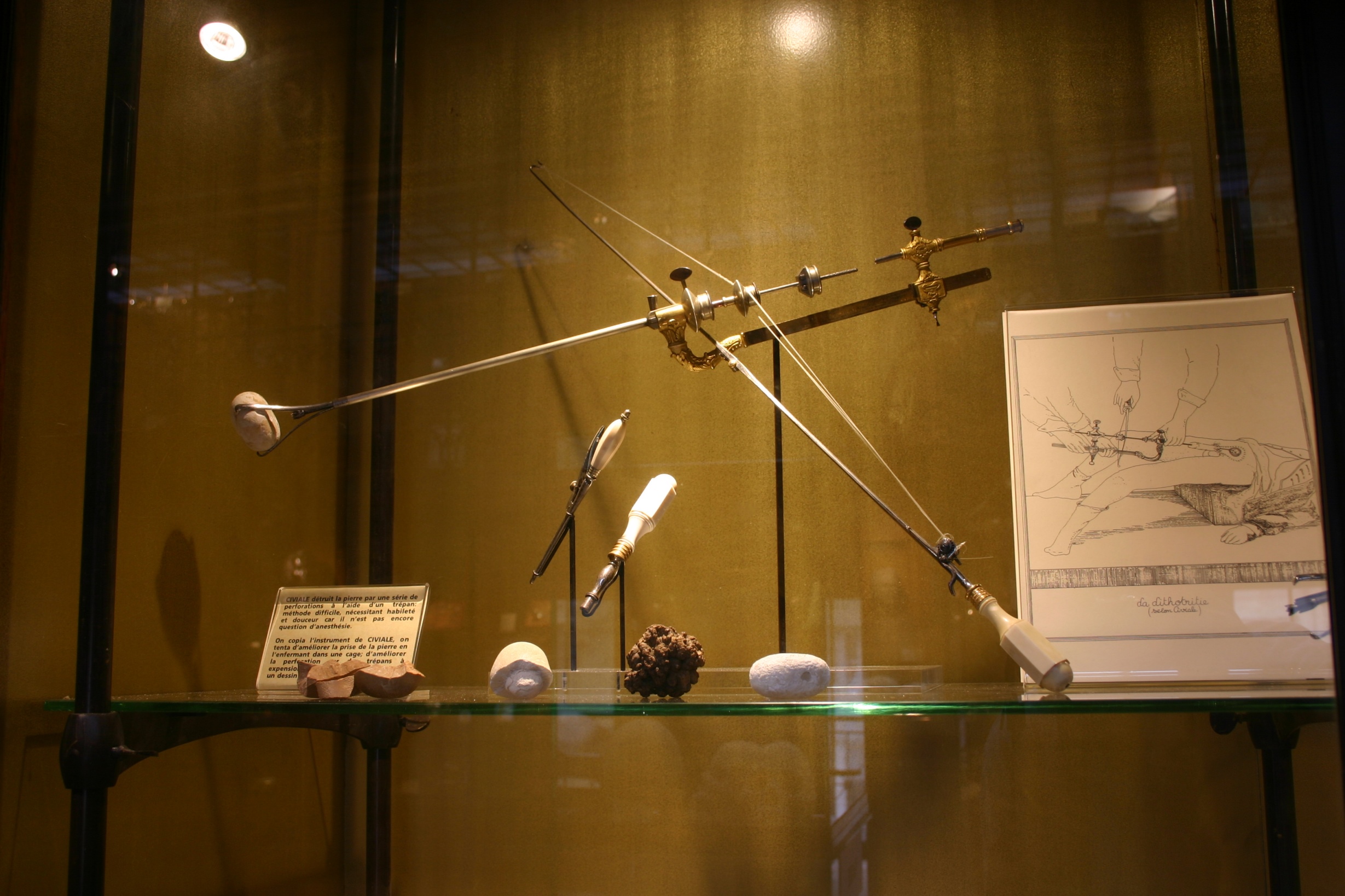 Jean Civiale's lithotrite, Musée d'Histoire de la Médecine, Paris (3).JPG